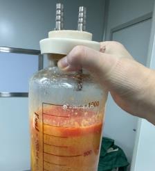 海门水动力吸脂手术要做多久？